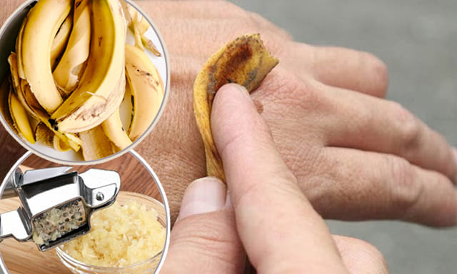 лечение бородавок банановой кожурой